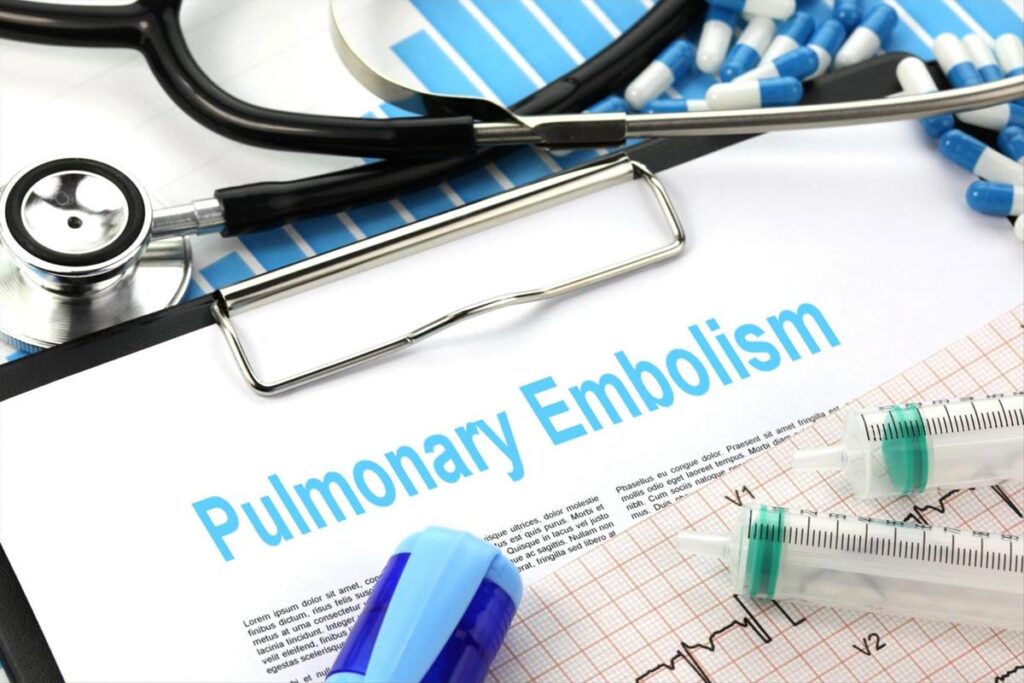 CT Scans: Essential for Diagnosing Pulmonary Embolism