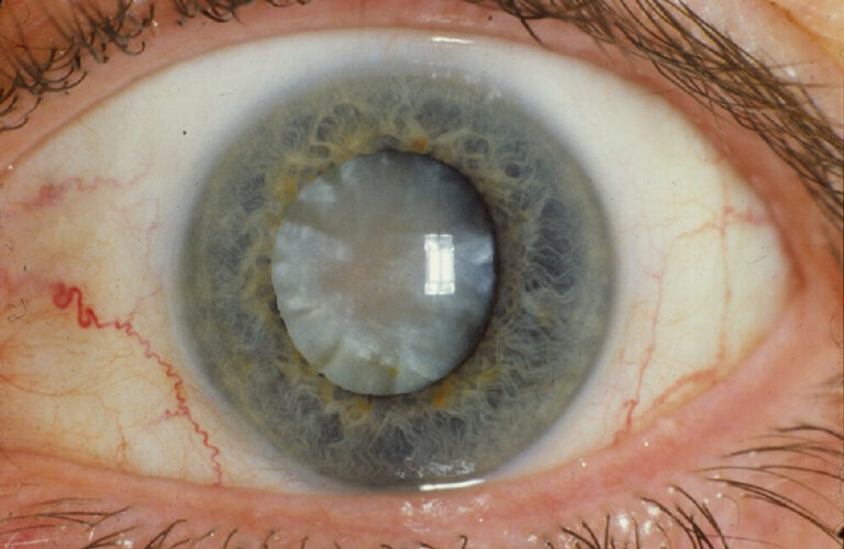 Common Myths About Cataracts Debunked