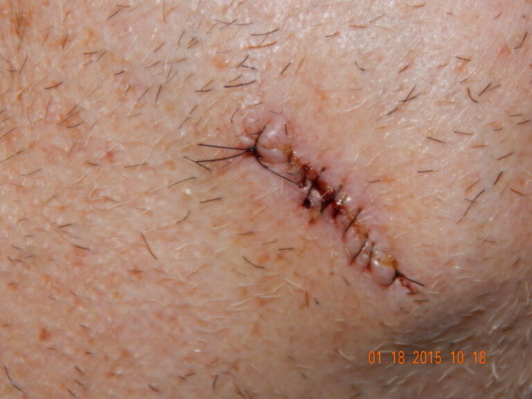 Five Signs You Might Need Mohs Surgery