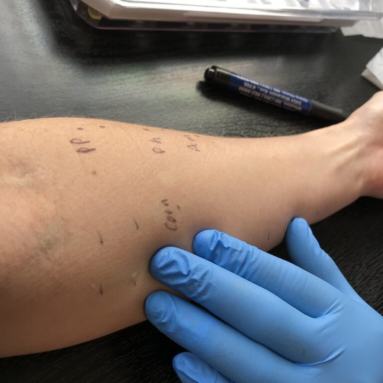 How Food Allergies Can Affect Your Skin