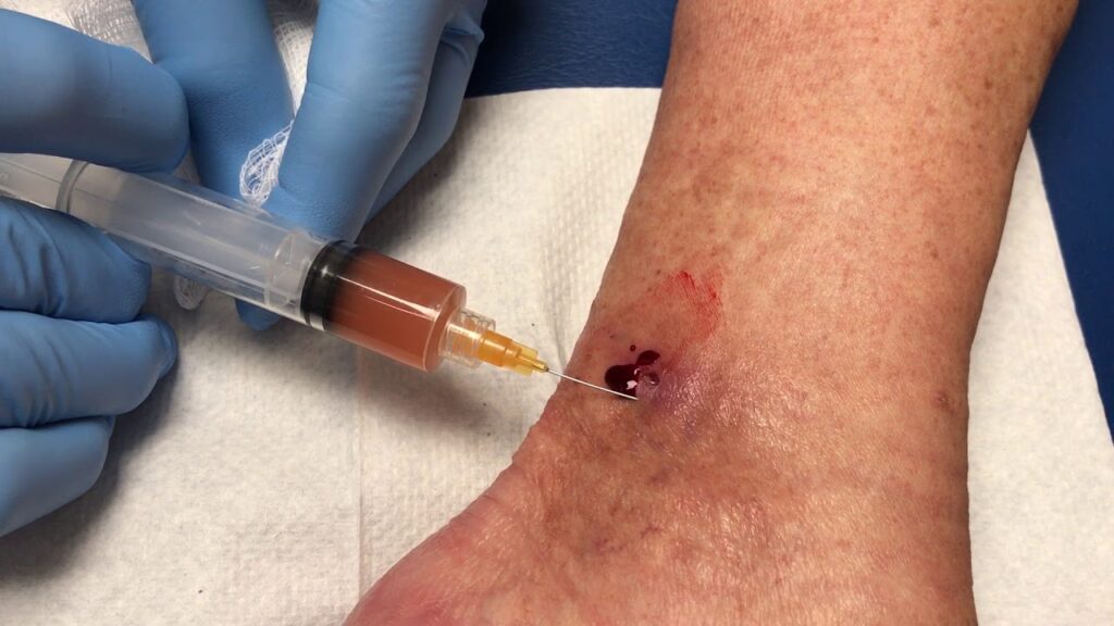 The Impact of Compression Therapy on Wound Healing