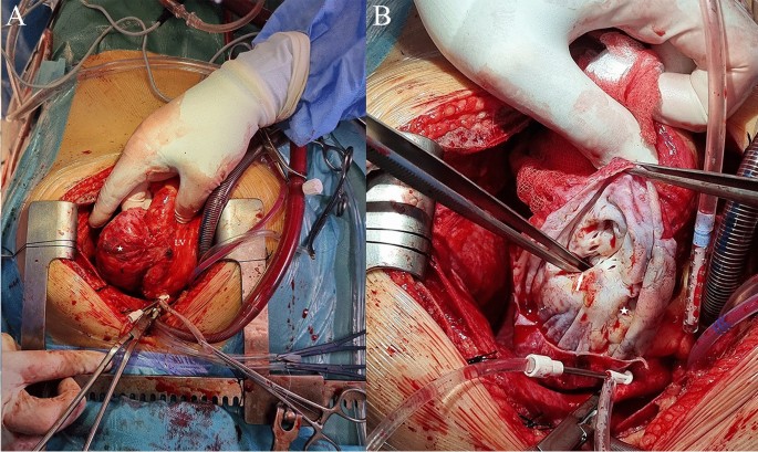 The Long-Term Effects of Vascular Disease on Heart and Circulatory Health