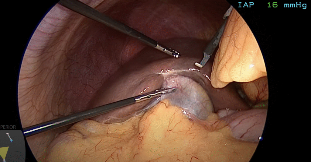 What To Expect During Gallbladder Surgery