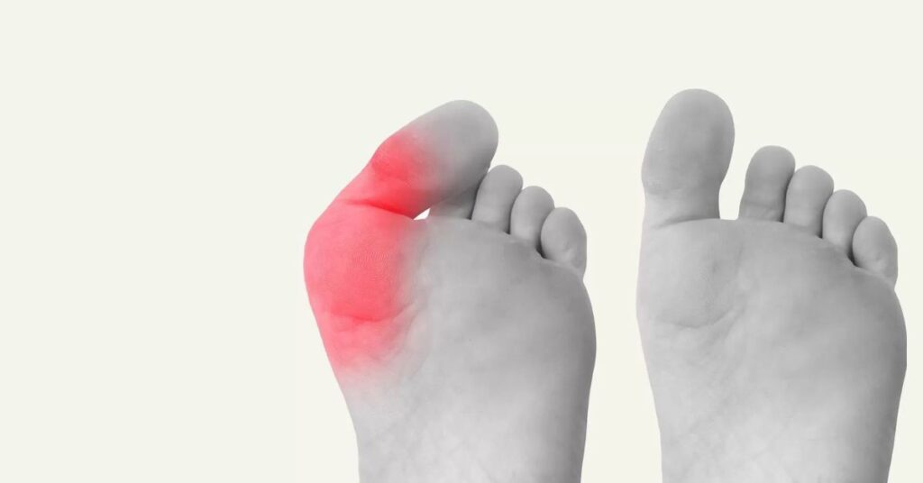 What are the best treatments for bunions without surgery