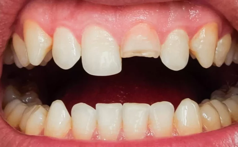 When a Cracked Tooth Requires Immediate Care