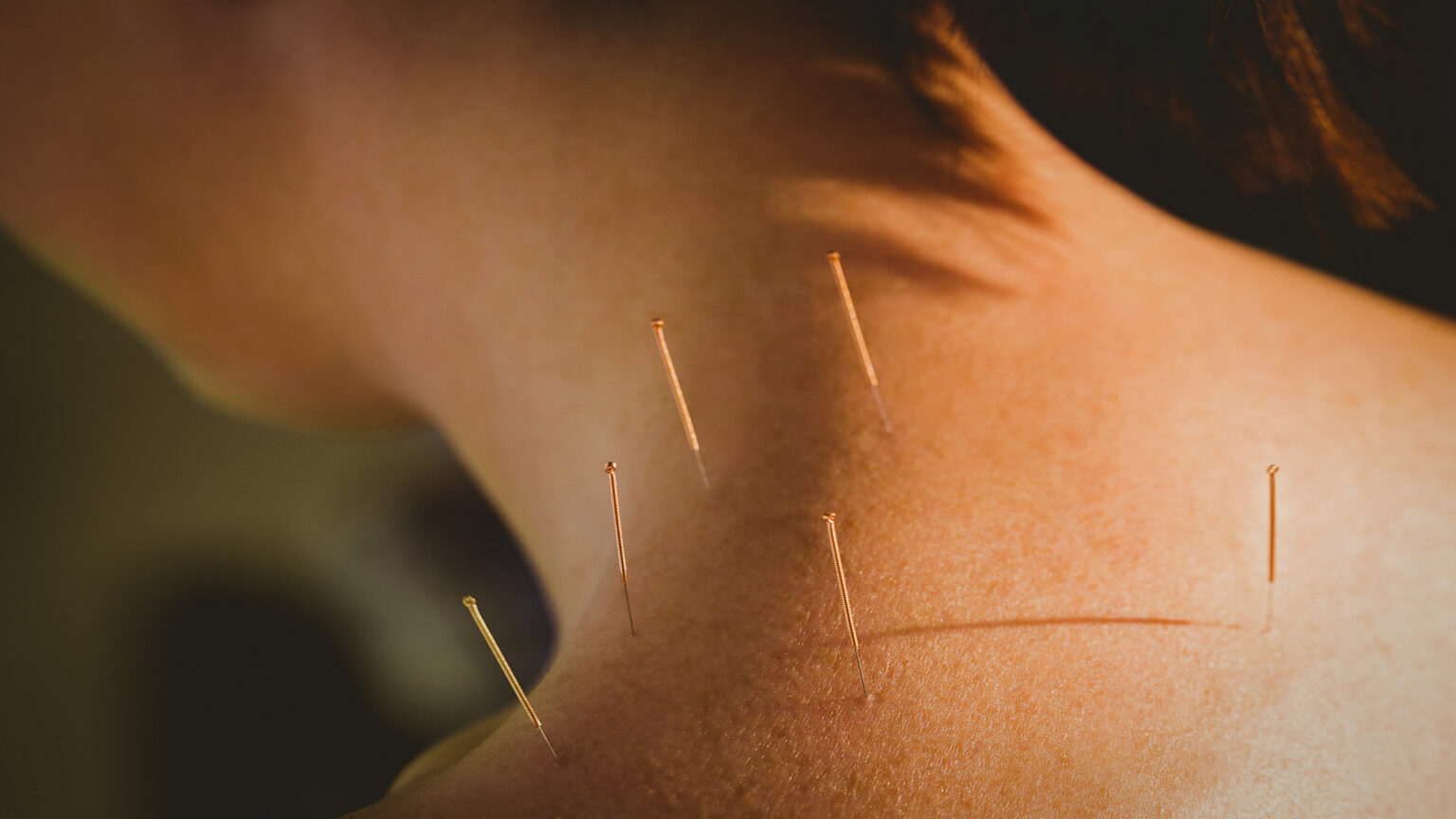 How Acupuncture Helps Improve Circulation and Boosts Healing