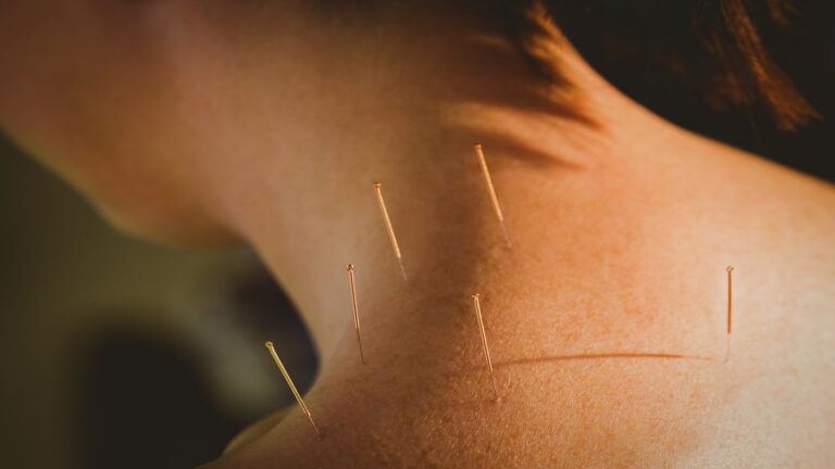 How Acupuncture Helps Improve Circulation and Boosts Healing