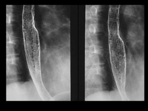 How EGD Can Help Diagnose Esophageal Issues