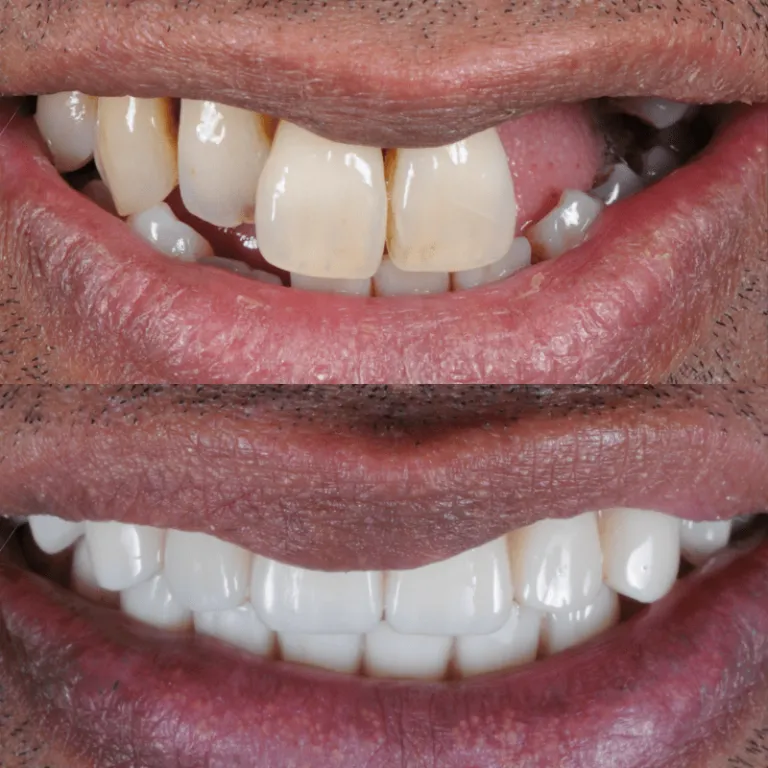 The Benefits of Endodontic Implants for Tooth Restoration