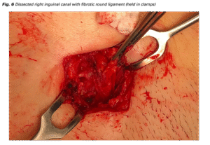 When Should You See a Gynecologist for Abnormal Bleeding?