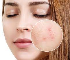 Caring for Different Skin Types in Dermatology Caring for Different Skin Types in Dermatology