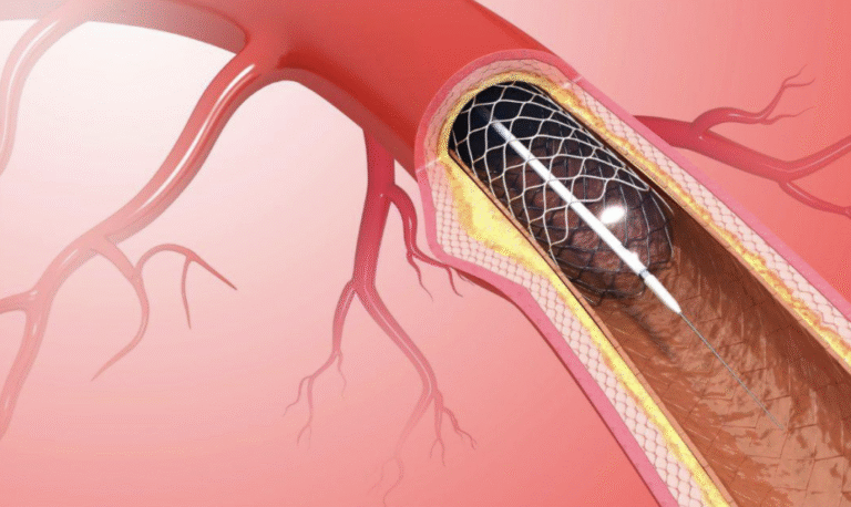 How Do Cardiologists Treat Coronary Artery Disease?