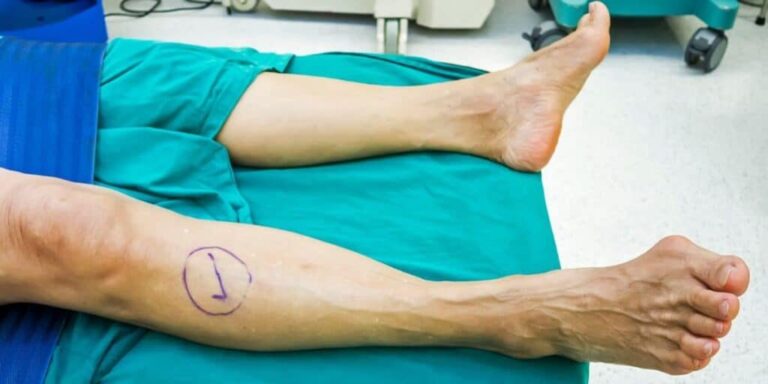 How Flat Feet Can Affect Athletic Performance