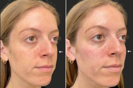How Long Do Facial Fillers Last? How Long Do Facial Fillers Last?
