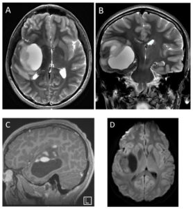 How Pediatric Imaging Ensures Safe Screening for Pediatric Tumors
