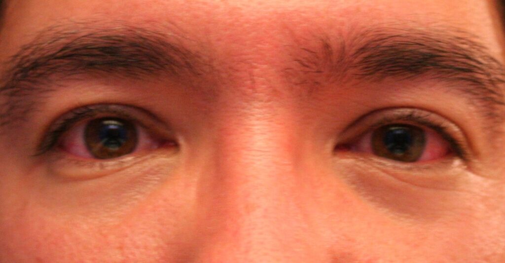 How To Treat Red Eyes From Allergies and Irritation
