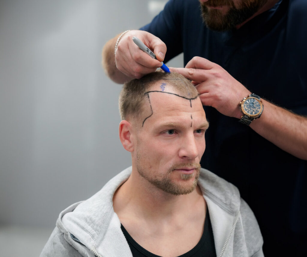 How to Get the Most Out of Your Hair Transplant