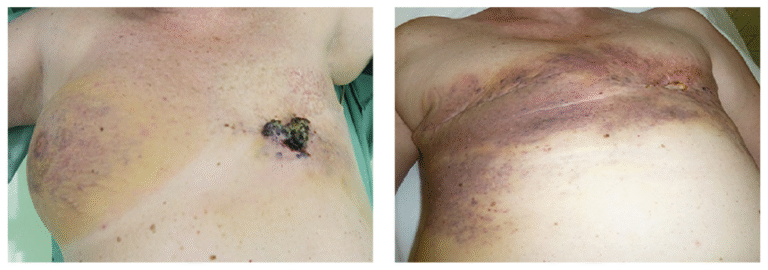Side Effects of Radiation Therapy