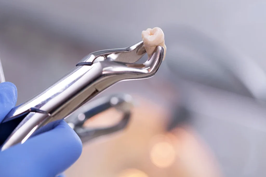 Tooth Extraction: When Is It Absolutely Necessary?