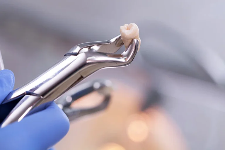 Tooth Extraction: When Is It Absolutely Necessary?