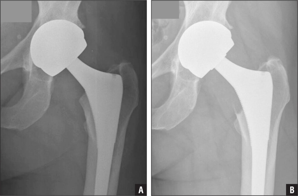 Understanding Hip Replacement Surgery: Conditions That May Require It