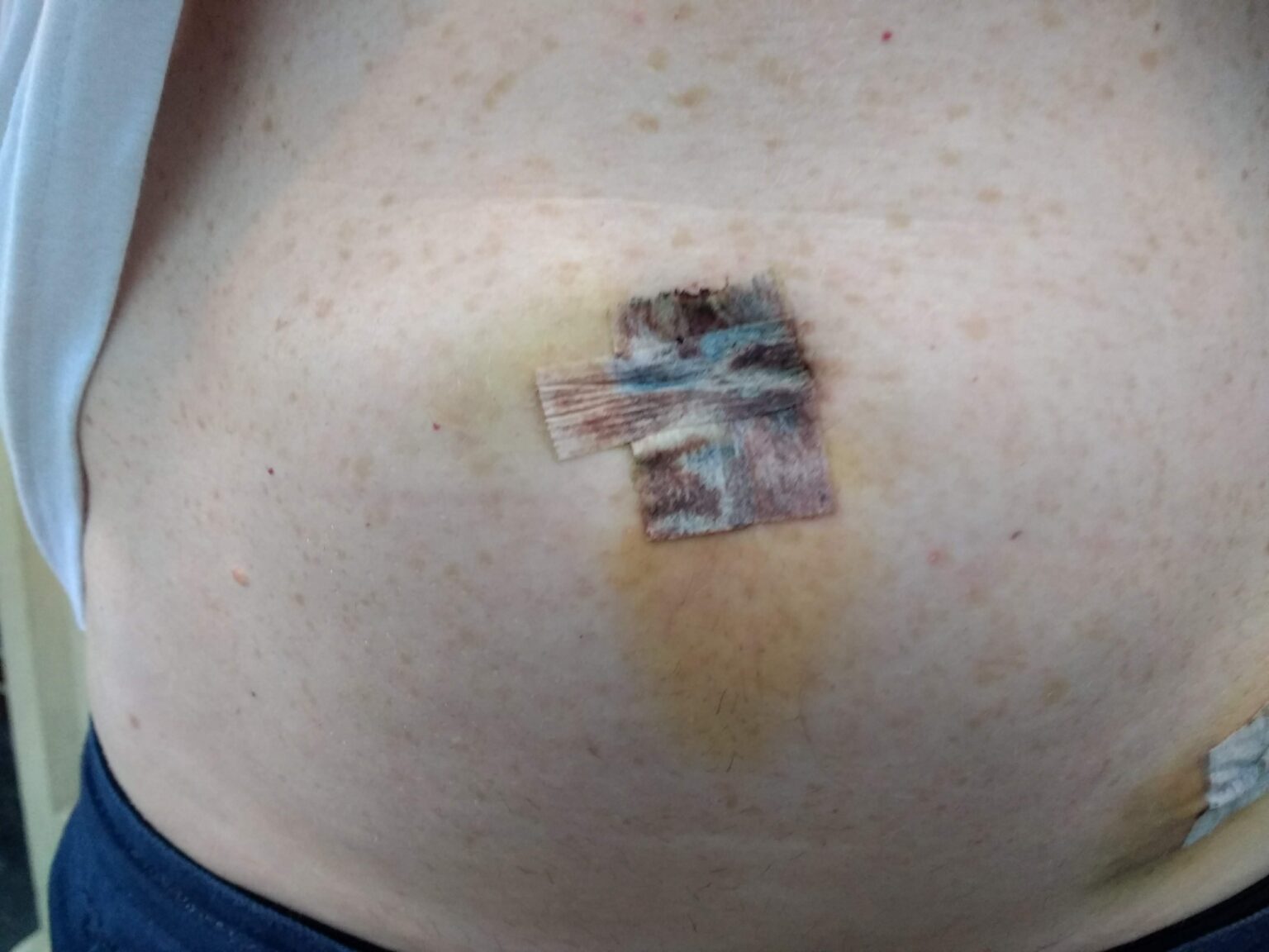 Understanding the Recovery Process After Gallbladder Surgery