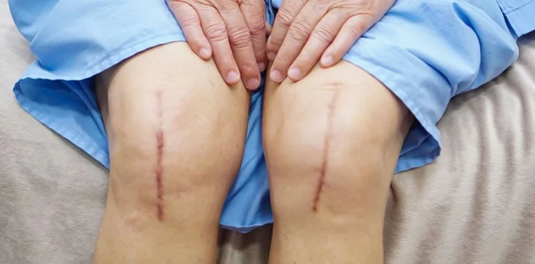 What To Expect Before and After Knee Replacement Surgery