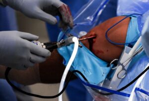 What Is Arthroscopy and How Is It Used in Orthopedics?