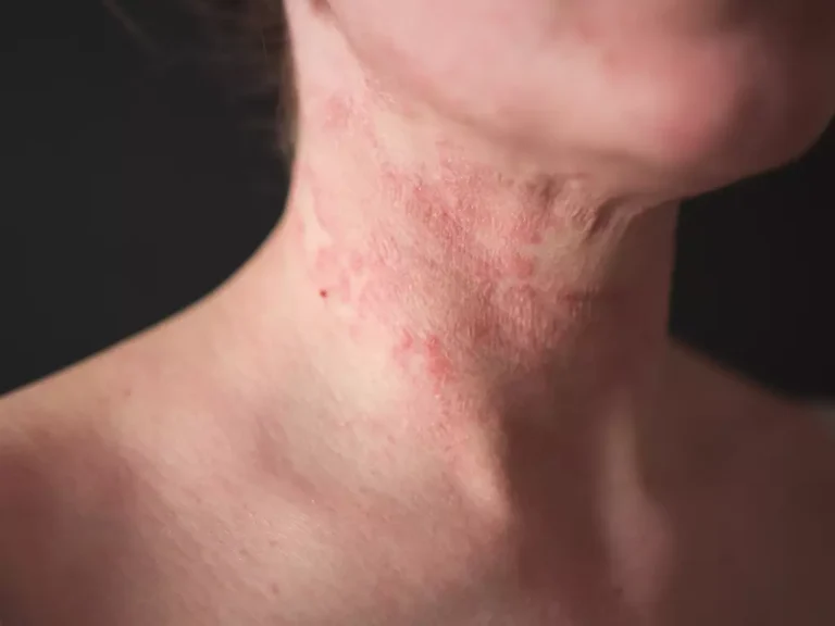 How to Reduce Eczema Flare-Ups