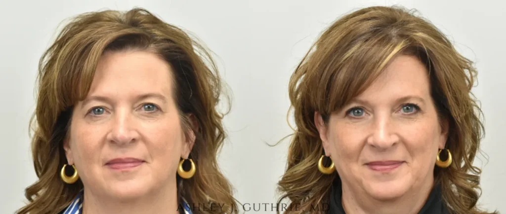 The Benefits of Blepharoplasty for Enhancing Your Appearance