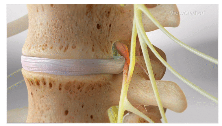 The Role of Minimally Invasive Spine Surgery in Treating Herniated Discs
